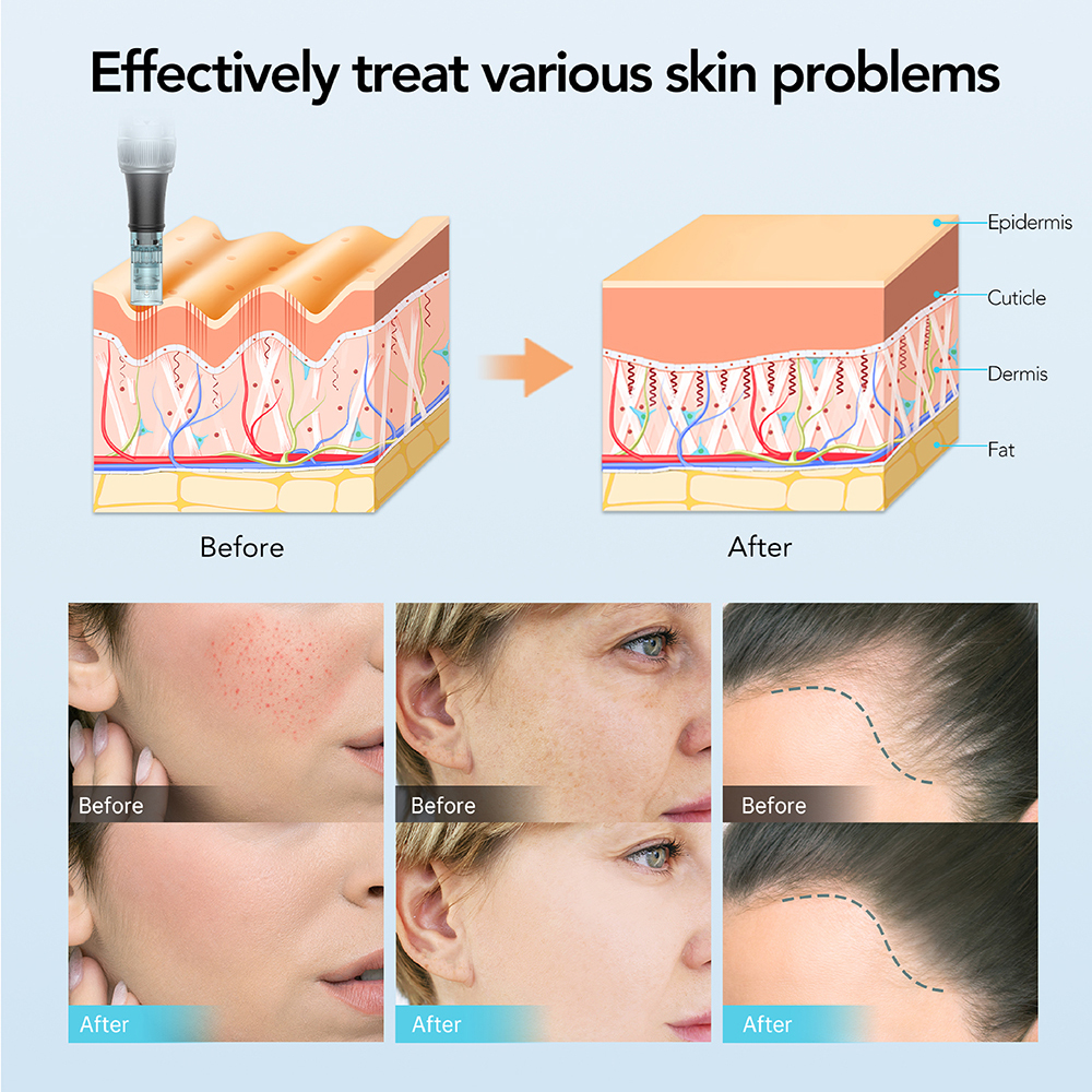 Dr. Pen M7S Microneedling Pen - Advanced Skin Rejuvenation & Hair Regrowth Solution 02