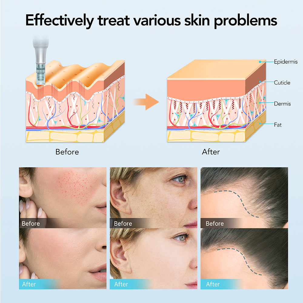 Dr. Pen M7S - Professional-Grade Microneedling Device 06